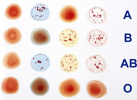Stem Cell Transplant